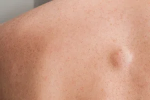 Imaginea prezintă un lipoame de grasime, oferind o reprezentare vizuală a acestei formațiuni grăsoase sub piele. Lipomul este vazut ca fiind cea mai frecventă tumoare benignă a ţesutului subcutanat.