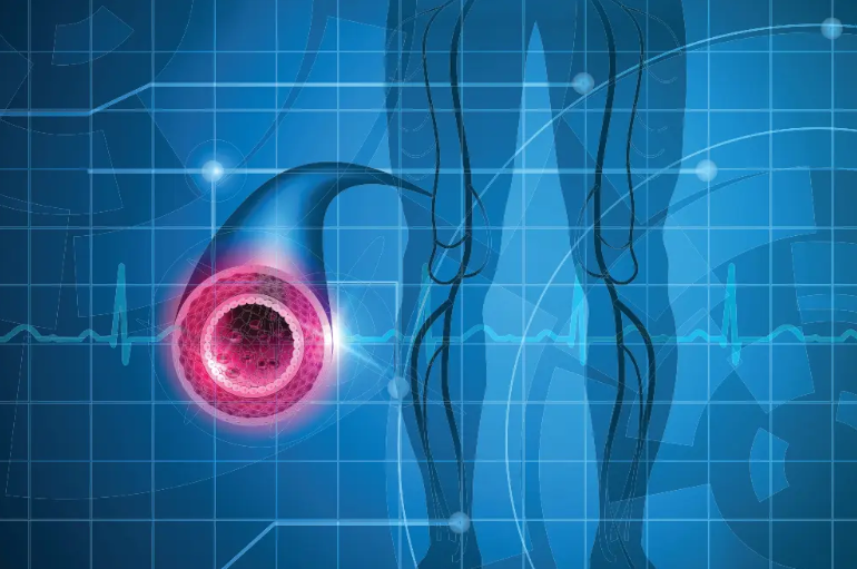Peripheral Arterial Disease