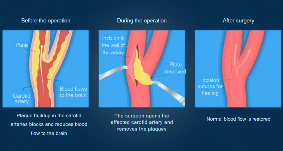 Carotid artery