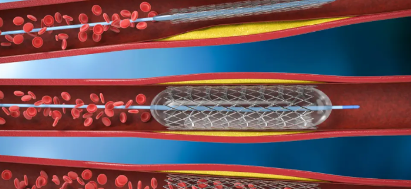 Venous stenting