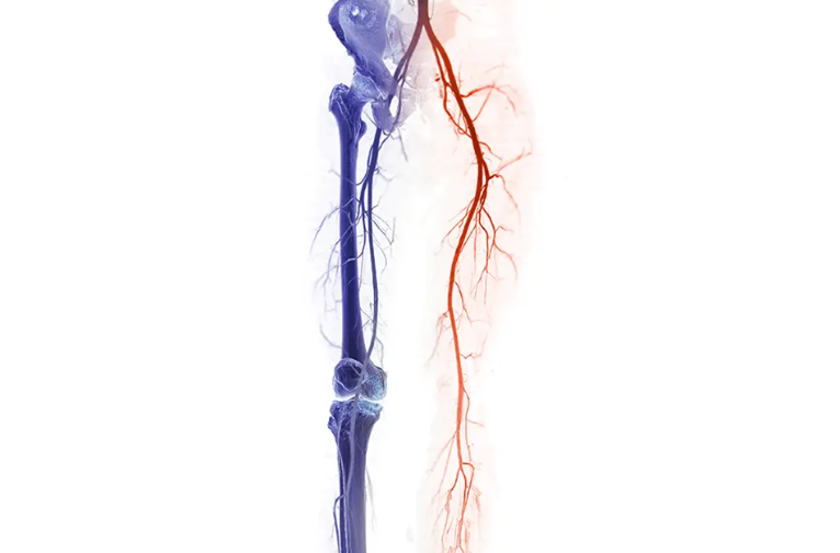 Endovascular Stent Graft Angioplasty