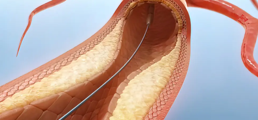 Arterial stenting