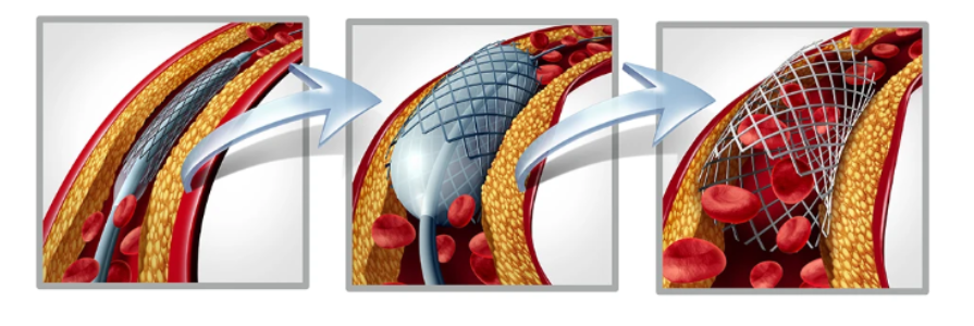 angioplasty and stent