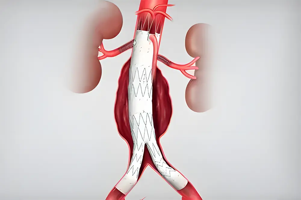 Poza ilustreaza o procedura EVAR pentru anevrismul aortic