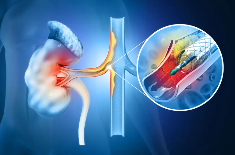 Total laparoscopic repair of restenosis renal artery after percutaneous transluminal renal stenting (PTRA)