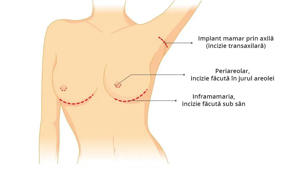 Imaginea ilustrează tipuri de cicatrici dupa operatia
de implant mamar zis si augmentare mamara.