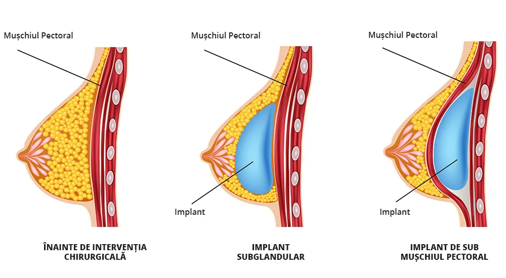 Imaginea ilustrează diferite tipuri de implant mamar.
