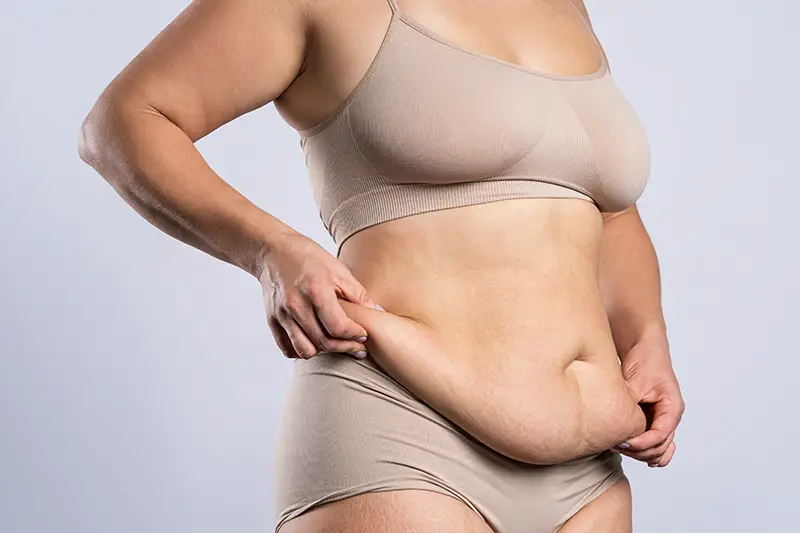 Poza reprezentativa pentru procedura de abdominoplastie, cu o femeie cu exces de piele dupa ce a slabit in greutate.