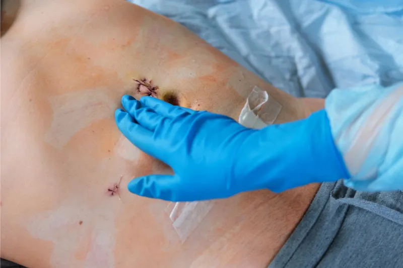 Poza reprezentavica pentru eventratie abdominala