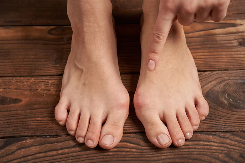 Poza reprezentativa pentru operatie hallux valgus si tratamentul pentru monturi.
