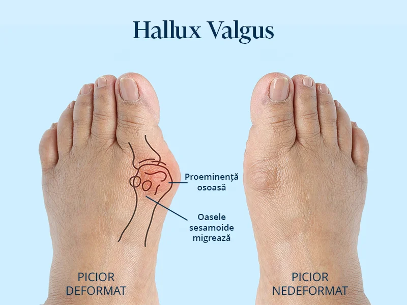 Rezultatele după operatia de hallux valgus, tratament pentru monturi.
