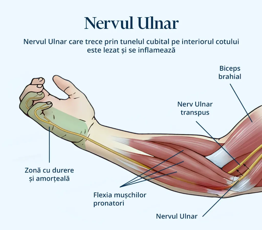 Poza reprezentativa nervul ulnar care trece prin tunelul cubital pe interiorul este lezat si se inflameaza.