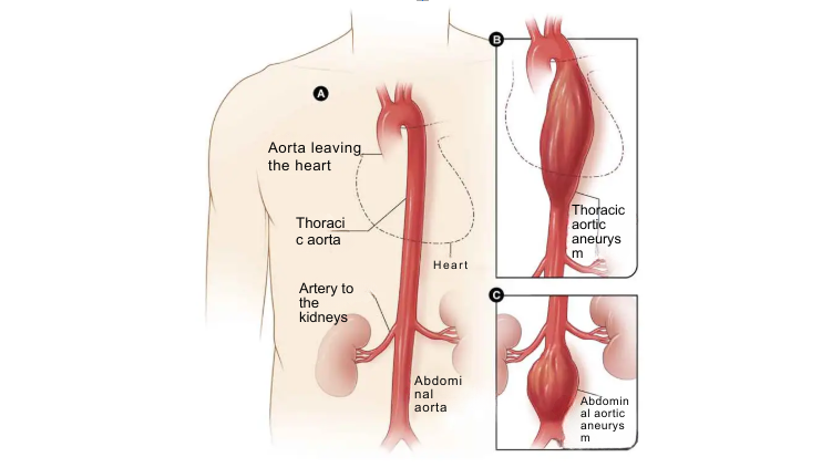 aortic aneurysm