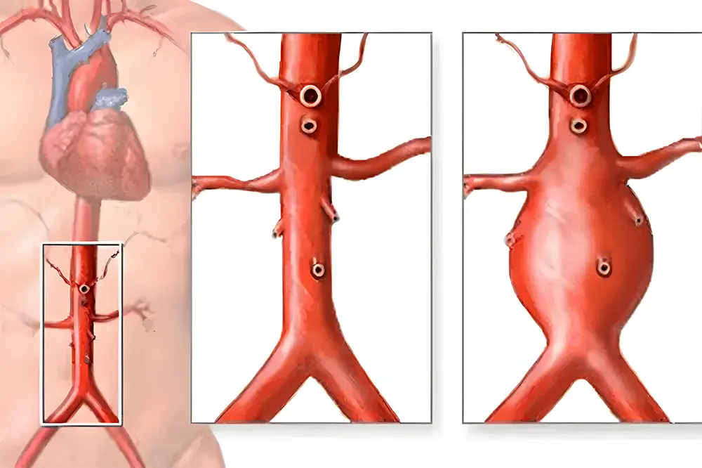 Aortic Aneurysm