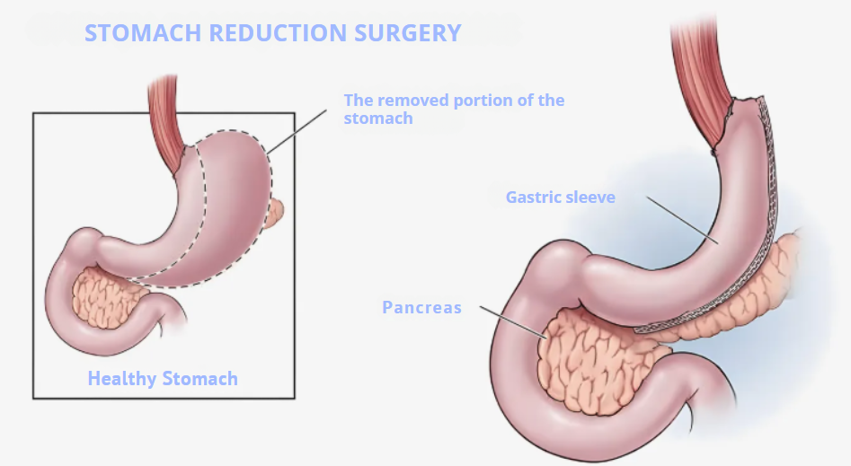 Gastric sleeve