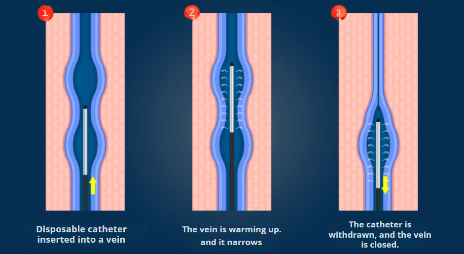 Representative photo of the VNUS Radiofrequency procedure