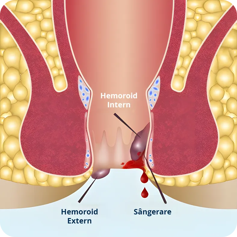 Desen grafic ilustrând hemoroizii interni si hemoroizi externi. sângerarea din cauza hemoroizilor.
