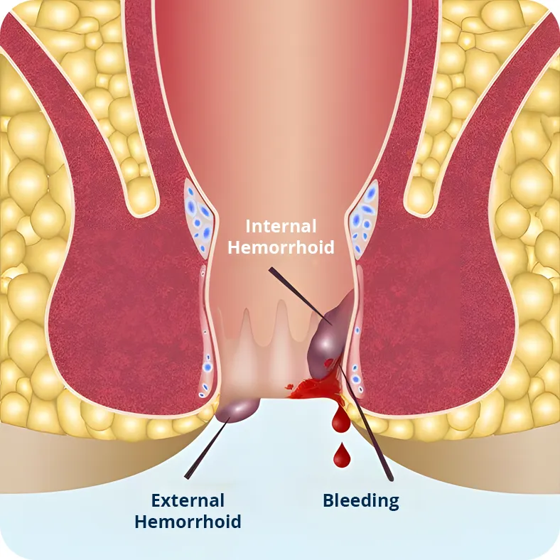 Graphic drawing illustrating internal hemorrhoids and external hemorrhoids. Bleeding due to hemorrhoids.
