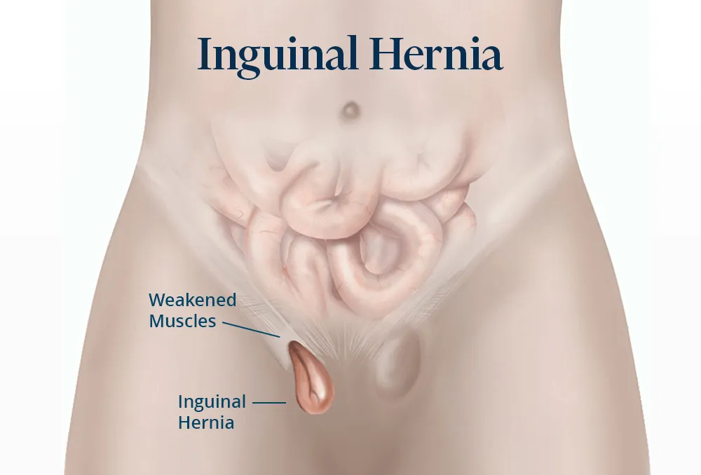 The picture shows what an inguinal hernia looks like