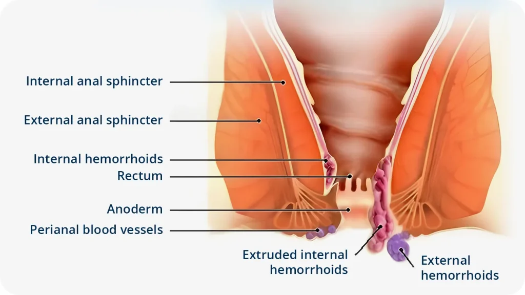 Detailed graphic drawing illustrating internal hemorrhoids and external hemorrhoids.