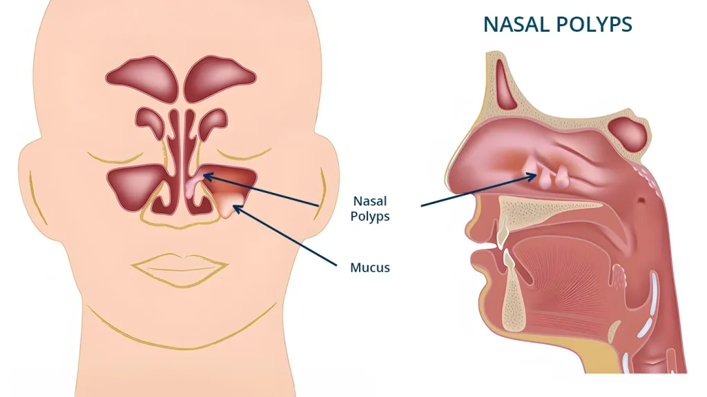 Drawing detailing what nasal polyps look like
