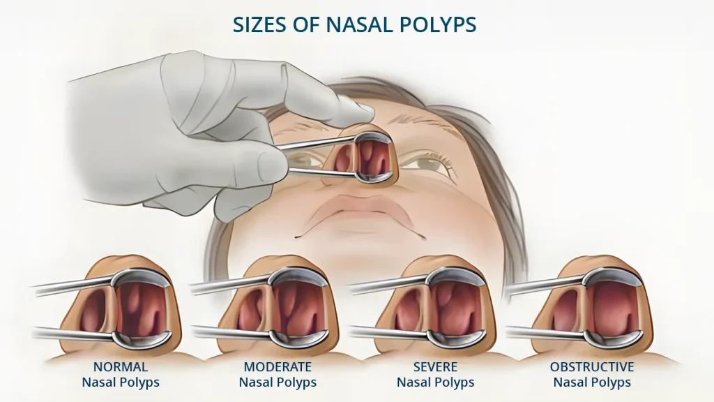 Drawing detailing the size untreated nasal polyps can grow to