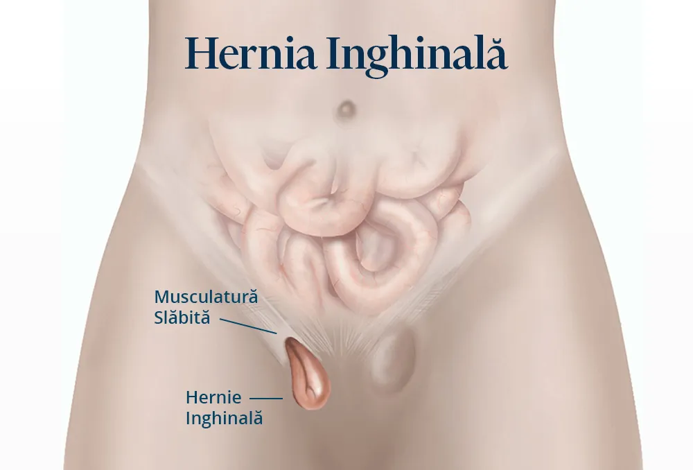 Poza reprezinta cum arata hernia inghinala