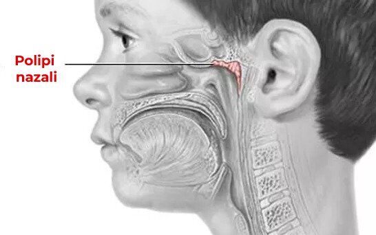 Desen ilustrativ cu un cap de om în care se evidențiază polipii nazali afla mai multe despre: Polipi nazali tratament.