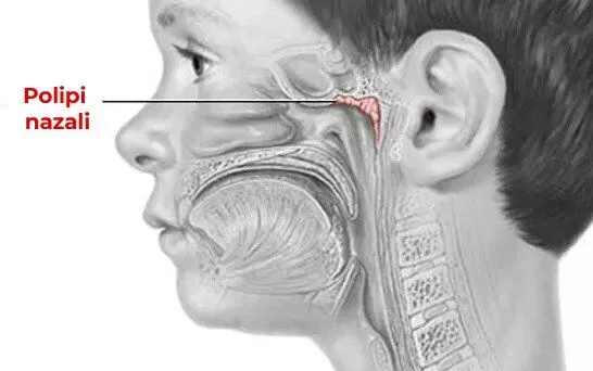 Desen ilustrativ cu un cap de om în care se evidențiază polipii nazali afla mai multe despre: Polipi nazali tratament.