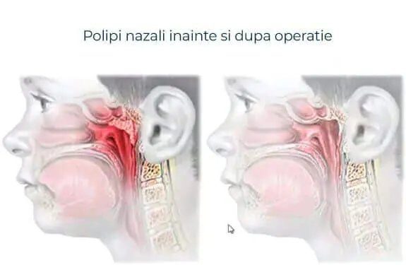Desen ilustrativ cu polipii nazali înainte și după operație. Vizualizeaza diferenta intre polipi nazali.