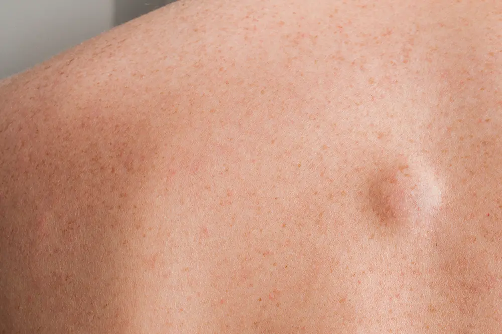 The image shows a fatty lipoma, providing a visual representation of this fatty formation under the skin. Lipoma is considered to be the most common benign tumor of the subcutaneous tissue.