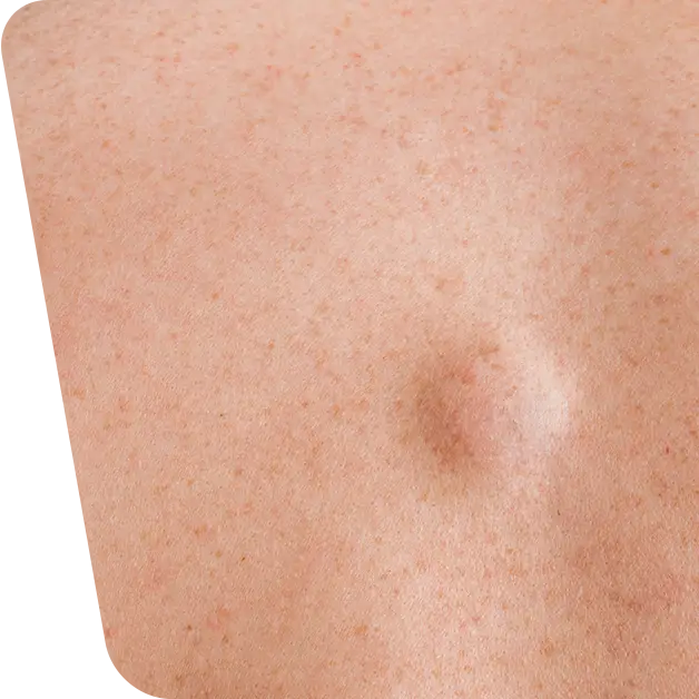 Imaginea prezintă un lipom, oferind o reprezentare vizuală a acestei formațiuni grăsoase sub piele.