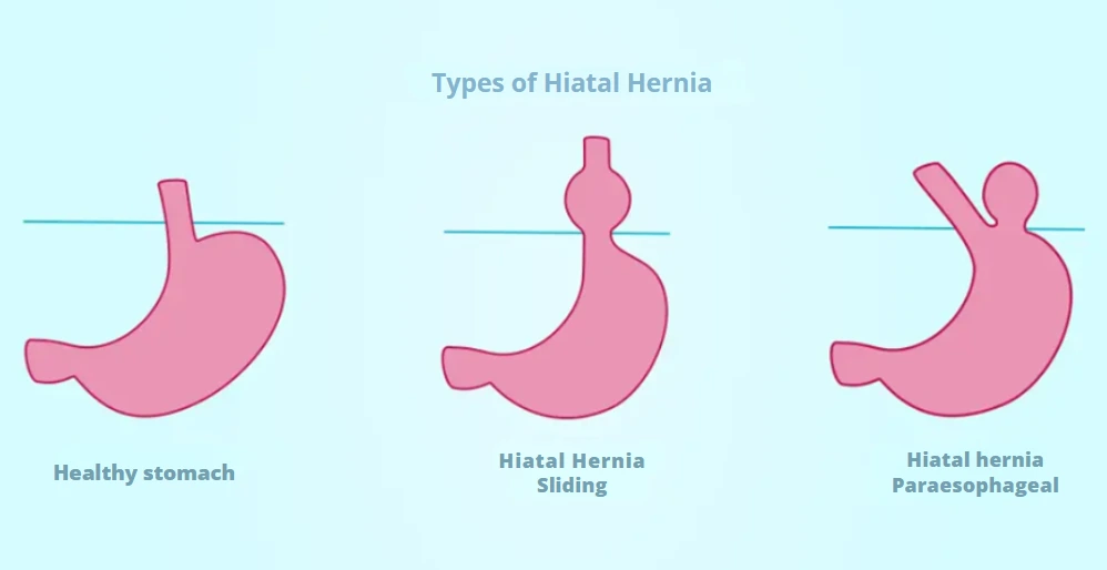 Image that shows the types of Hiatal Hernia