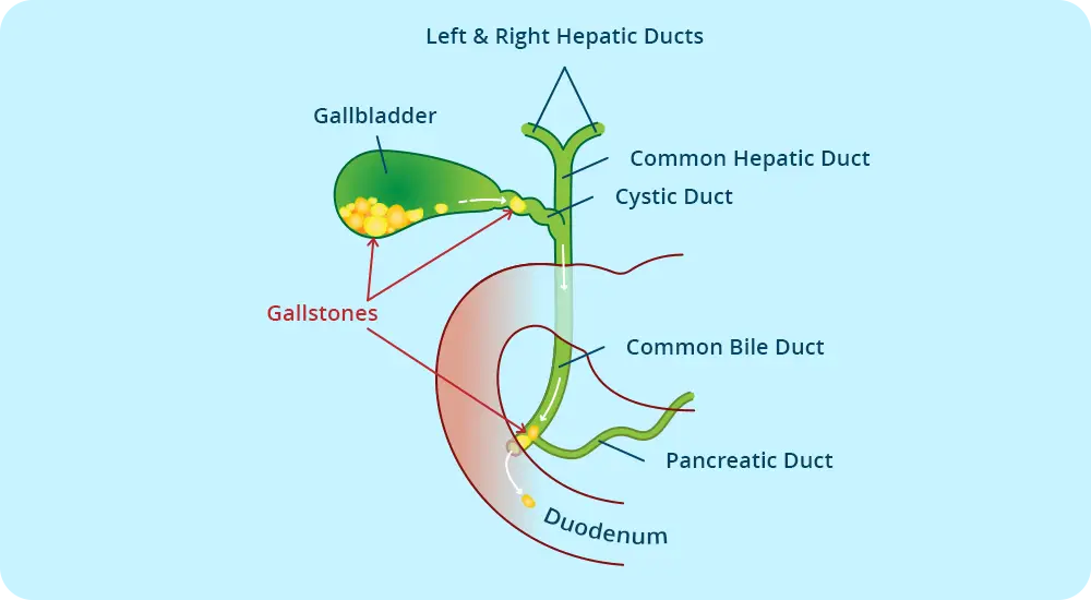 The image shows a detailed illustrative drawing of the left and right hepatic ducts with information about the gallbladder, gallstones, common bile duct, and duodenum
