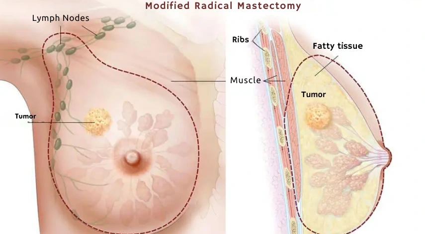 The image is an illustrative drawing showing what a modified radical mastectomy, lymph nodes, fatty tissue, and a tumor look like. This visual representation is associated with the information in the medical article about mastectomy.
