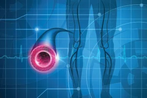 The image shows a graphic representation of the arteries in the legs, highlighting aspects associated with peripheral artery disease. Learn more about the diagnosis, treatment, and management of this condition in our specialized article.