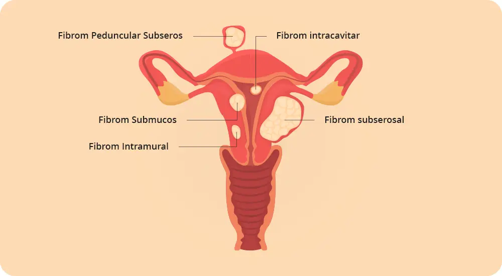 Fribrom uterin