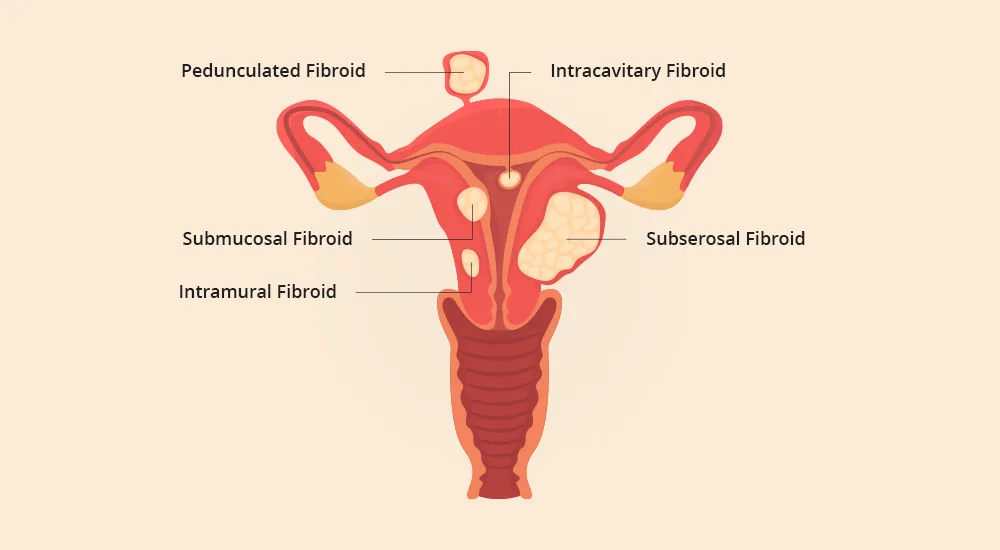 The image illustrates the types of uterine fibroids. Learn more about personalized approaches to uterine fibroid management in our specialized article.