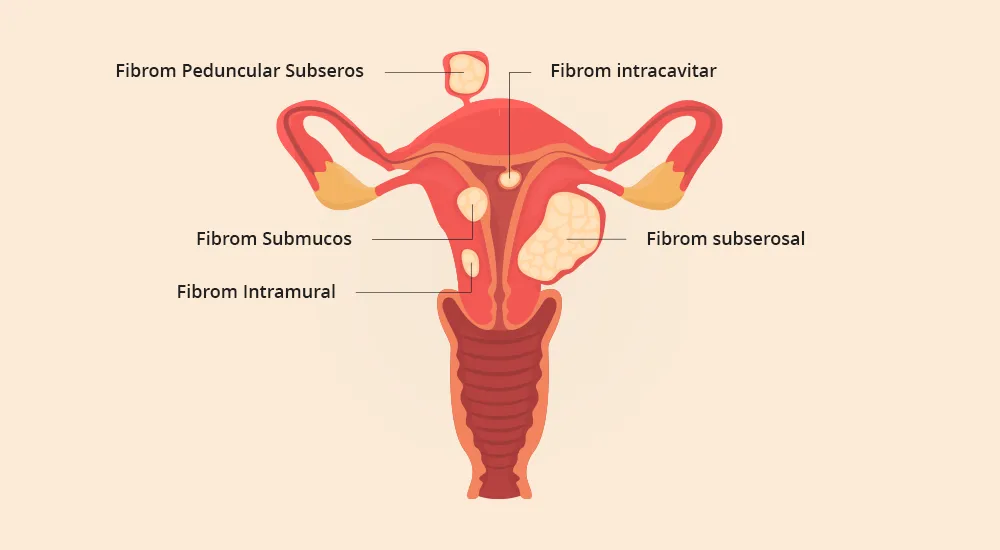 Imaginea ilustrează tipurile de fibrom uterin. Aflați mai multe despre abordările personalizate în gestionarea fibromului uterin în articolul nostru specializat.