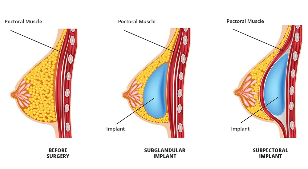 The image illustrates different types of breast implants, also known as breast augmentation.