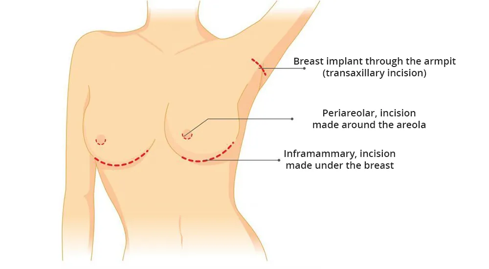 The image illustrates types of scars after breast implant surgery, also known as breast augmentation.