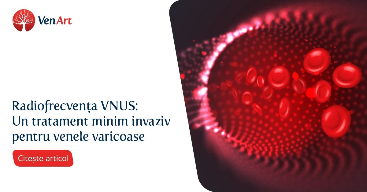 Clinica VenArt - Radiofrecventa VNUS tratament minim invaziv vene varicoase