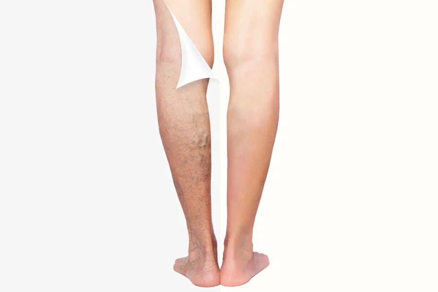 Imaginea prezintă o comparație a picioarelor înainte și după tratarea bolii venoase, varice. Ilustrează îmbunătățirile estetice și de sănătate obținute prin intervenția medicală. Aflați mai multe despre opțiunile de tratament și gestionarea varicelor în articolul nostru specializat.