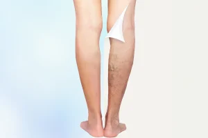The image highlights the transformation of a pair of legs affected by varicose veins, before and after the treatment procedure. Discover the remarkable results of the intervention in our specialized article on varicose vein treatment.