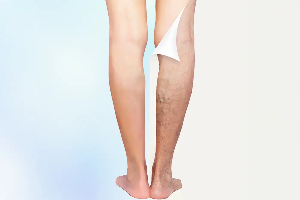 The image highlights the transformation of a pair of legs affected by varicose veins, before and after the treatment procedure. Discover the remarkable results of the intervention in our specialized article on varicose vein treatment.