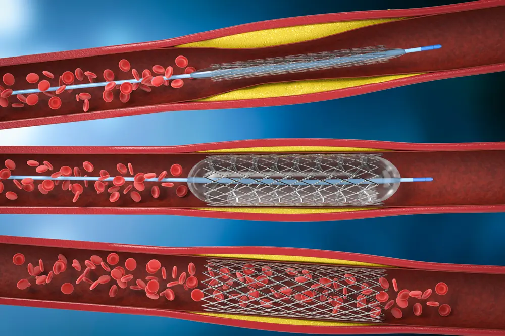 The image captures the venous stenting process, highlighting the surgical procedure and how the stent is placed to improve venous flow. Learn more about this procedure and its benefits in our specialized article.