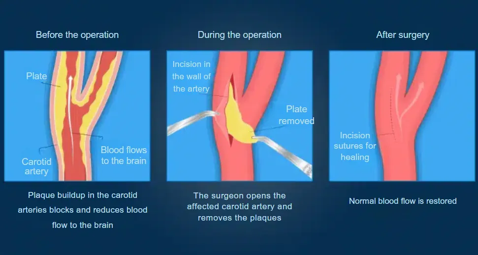 Carotid artery bypass surgery