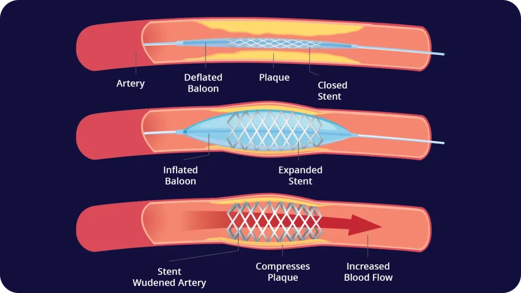 Detailed drawing of venous stent placement procedure