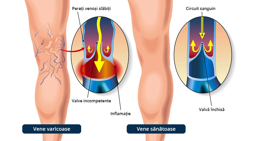 tratament varice vene varicoase artere clinica vasculara cluj napoca bucuresti venart