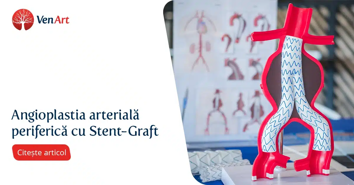 VenArt - Angioplastia arterială periferică cu Stent Graft